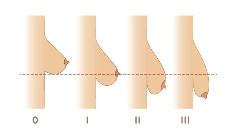 Breast shape classification diagram.