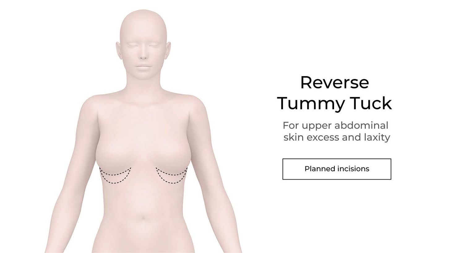 Illustration of a reverse tummy tuck procedure.