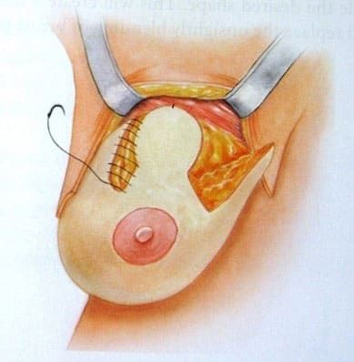 Breast Enhancement