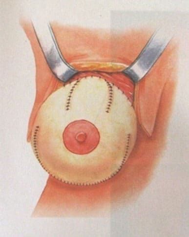 Breast Enhancement