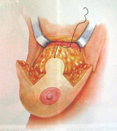 Breast Enhancement
