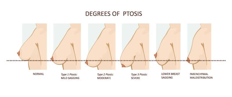 Breast Enhancement