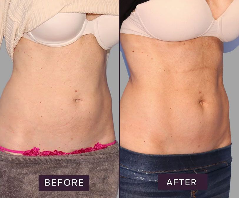 Before and after body transformation comparison image.