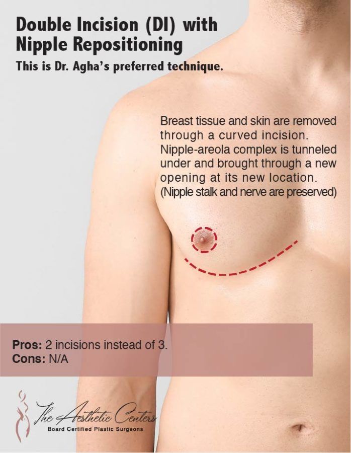 FTM Top Surgery Newport Beach￼