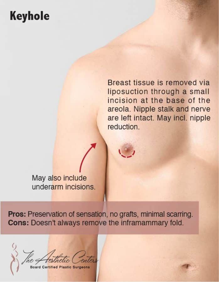 FTM Top Surgery Newport Beach￼