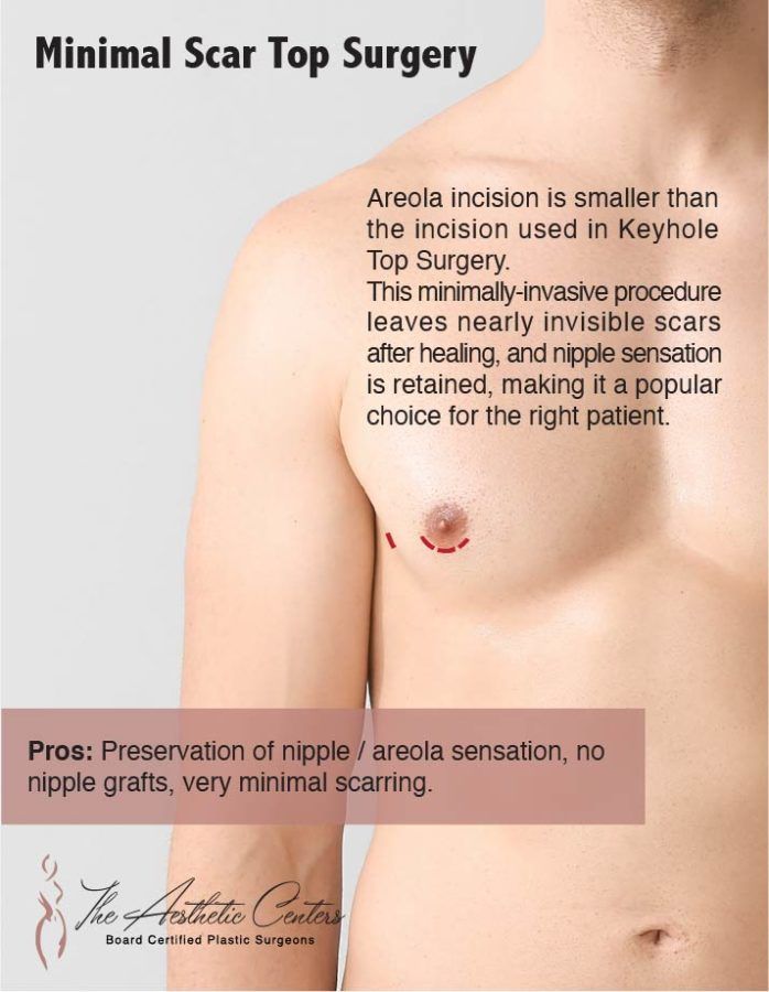 FTM Top Surgery Newport Beach￼