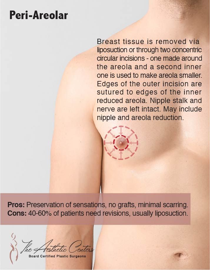 FTM Top Surgery Newport Beach￼