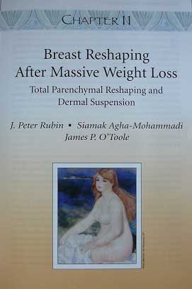 Aesthetic Surgery After Massive Weight Loss book cover