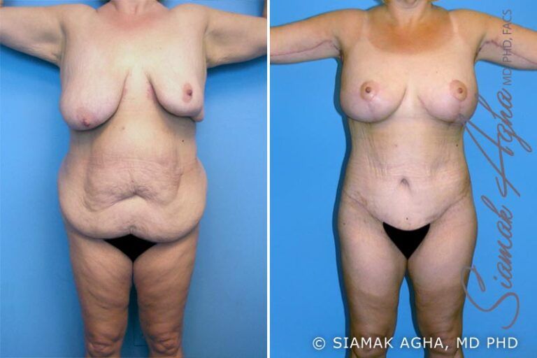 Before and after body contouring surgery comparison.