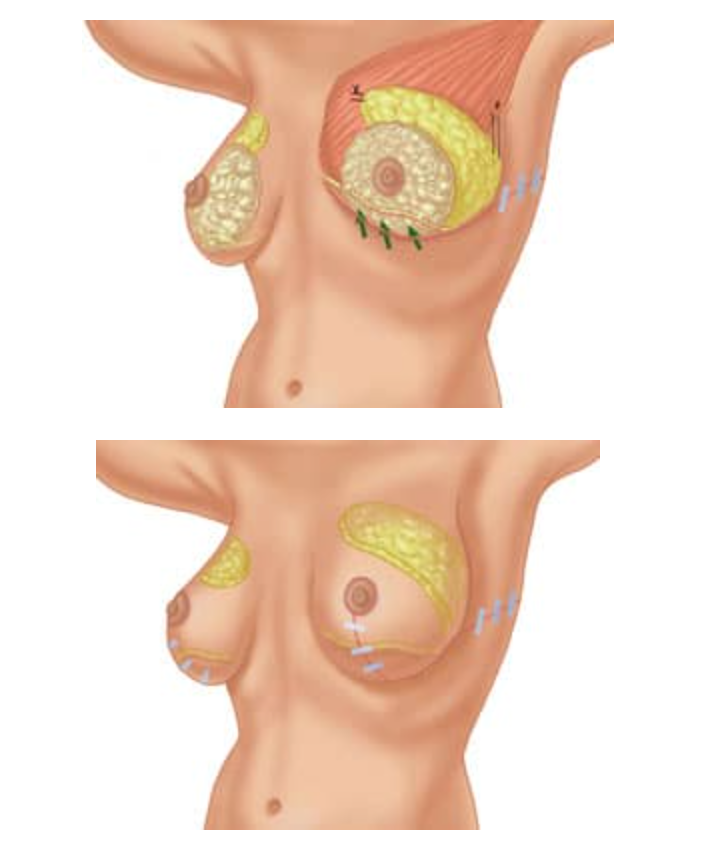 Breast Enhancement