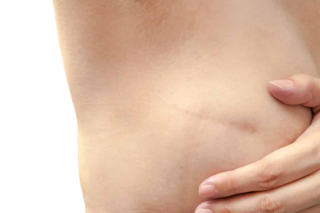 3 Common Misconceptions About Breast Reconstruction That Should Be Cleared Up